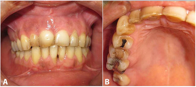 Intra oral examination - A and B showing no alteration of the upper teeth gingiva.