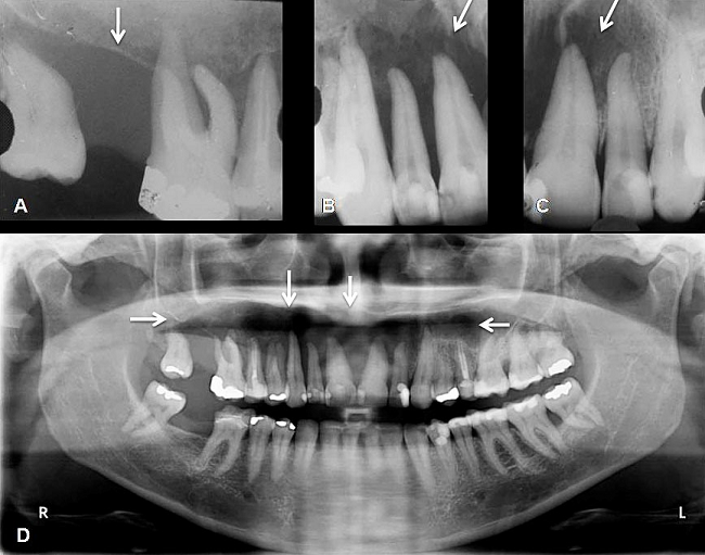 A-C - Periapical radiographs show a large reabsorption of the alveolar bone and floating teeth (arrows); D - Panoramic x-ray shows irregular osteolytic image in the right maxilla (arrows).