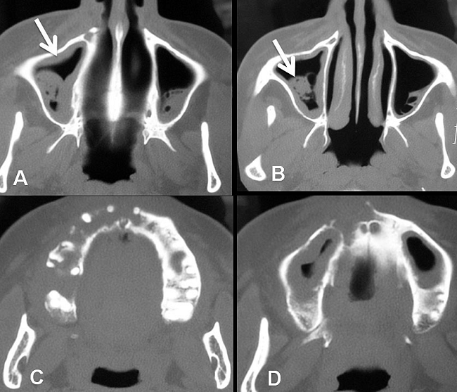A - Axial computed tomography (CT) image of the paranasal sinuses showing the thickening of the sinus mucosa (arrow); B - Axial CT image of polypoid lesions within the sinus (arrow); C and D - Axial CT images of the maxilla showing an extensive reabsorption of alveolar bone of right maxilla.
