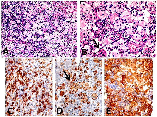 Photomicrography of the biopsy. A - A diffuse inflammatory infiltrate rich in xanthomatous macrophages (H&E 40X); B - Evident lymphocytes emperipolesis is also observed (arrow) (H&E 200X); C - CD3 positive for reactive cells (T lymphocyte cells); D - CD68 showed strong positivity for macrophages with lymphocytes emperipolesis (arrow); E - S-100 was positive in histiocytic cells.