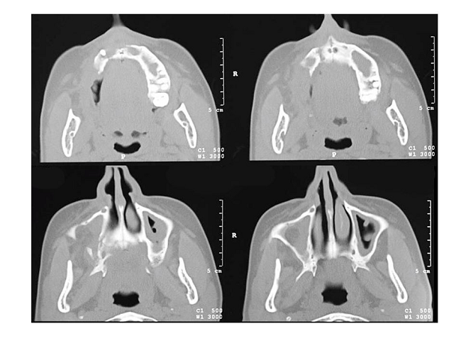 Axial CT images showing sinusopathy in both maxillary sinuses, and control of the bone reabsorption.