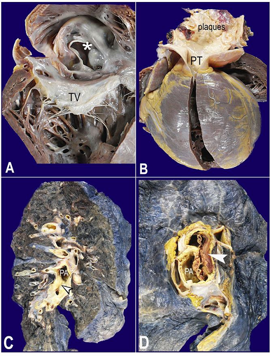 A and B - Gross examination of the heart. A - Opened right cardiac chambers. The asterisk marks the atrial septal defect located at the fossa ovalis (so-called secundum defect); B - The right ventricle hypertrophy and pulmonary artery trunk (PT) dilation with atherosclerotic plaques; C and D - Macroscopic findings of the lungs; C - The dilation and atherosclerosis of the pulmonary artery (PA) (arrowhead points to a plaque) and its branches; D - PA thrombosis (white arrowhead). TV = tricuspid valve.
