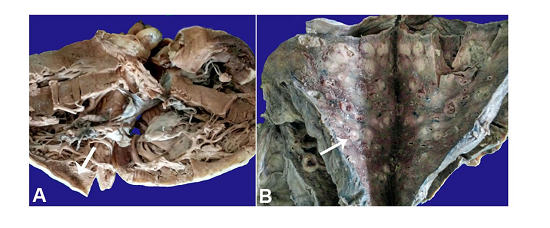 A - Gross specimen of the heart showing the grey-white area in the region of the interventricular septum and the right ventricular wall; B - Gross specimen of the lung showing multiple friable grey-white necrotic areas on the cut section.
