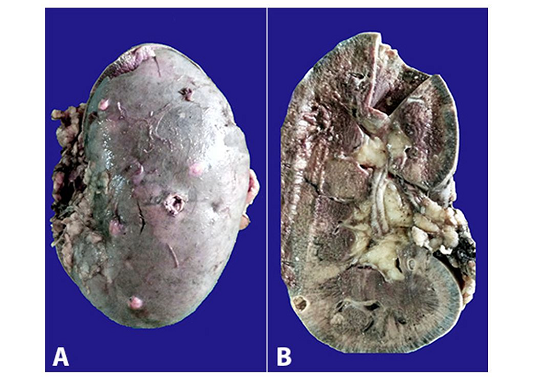 Gross examination of the kidney. A - Multiple nodular and cavitary lesions on the external surface; B - A cystic lesion on the cut surface.