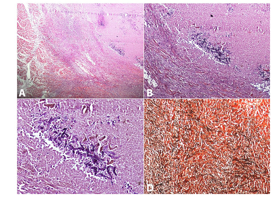 Photomicrophotographs of the heart, which reveal the destruction of cardiomyocytes intermingled with necrotic debris and fungal hyphae (A - H&E, 40X). The fungal hyphae were septate with acute angle branching, PAS positive (B - PAS, 100X & C - PAS, 400X) and GMS positive (D - GMS, 100X).