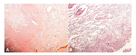 Photomicrophotographs of the lung (A - H&E, 100X) and kidney (B - PAS, 400X) revealing the presence of similar fungal hyphae.