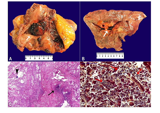 A - Gross examination of the heart showing an organized thrombus in the right atrium (arrow); B - Saddle pulmonary thromboembolism in the right lung (arrow); C - Micrography of the lungs showing suppurative bronchopneumonia (arrow) associated with colonies of cocci (arrowhead) (H&E, 55X); D - Gram-positive cocci in the areas of suppurative pneumonia (arrows) (Brown-Brenn, 400X).