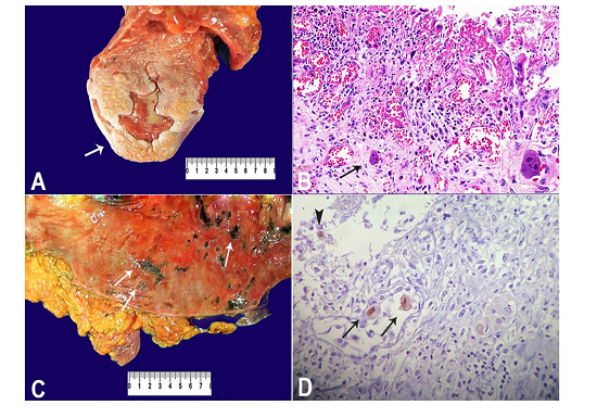 A - Gross examination of the tongue depicting an ulcer on the dorsum (arrow); B - Micrography of the tongue showing mucosal ulcer with endothelial cells exhibiting cytomegalic cytopathic effect (arrow and inset) (H&E, 300X); C - Macroscopic examination of the colonic mucosa exhibiting small ulcers (arrows); D - Micrography of the colon showing a positive immunohistochemistry reaction for cytomegalovirus (CMV) antigens, detecting cytomegalic endothelial (arrow) and inflammatory (arrow head) cells in a colonic ulcer, with nuclear staining (mouse anti-CMV cocktail of DDG9 and CCH2, Diagnostic BioSystems, 400X).