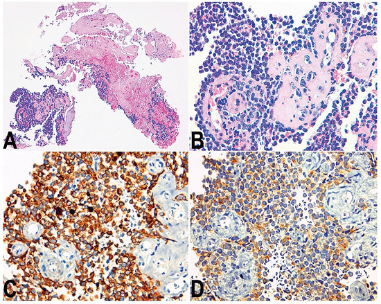 Photomicrography of the biopsy specimen. A - Extensive areas of necrosis (H&E, 100X); B - Sheets of small cells with high nuclear-cytoplasmic ratio surrounding the vessels (H&E, 400X); C - Positivity immunostaining for CAM 5.2 (400X); D - Focal positivity for synaptophysin (400X).