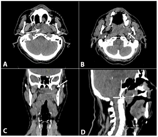 Planning CT scan showing the extensive nasopharyngeal lesion extending to the nasal fossae, parapharyngeal space, and pterygoid muscles, with soft palate invasion. A and B - Axial sections; C - Coronal section; D - Sagittal section.