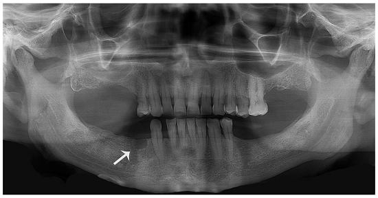Initial panoramic radiograph showing a radiolucent oval image with radiopaque halo in the premolar region (arrow).