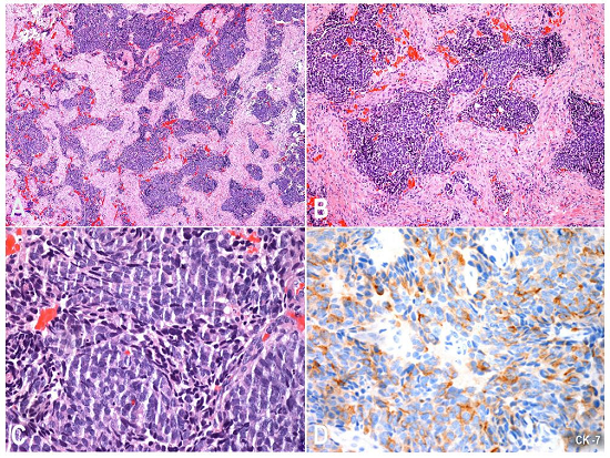 Photomicrography of the biopsy specimen showing in A and B - an infiltrative tumor composed of large cell blocks with irregular shapes and marked basophilia (H&E, 40X and 100X, respectively); C - Note that the cells had scant cytoplasm and hyperchromatic nuclei, some with crushing artifact (H&E, 400X). The immunohistochemical study showed in D positivity for cytokeratin 7 (200X).