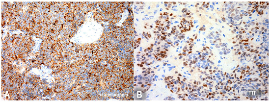 Photomicrography of the biopsy specimen showing in A positivity for chromogranin A (200X), and in B positivity for TTF-1 (200X).