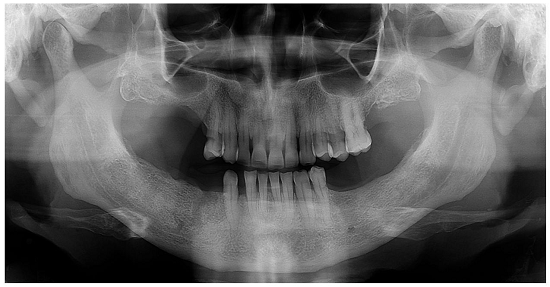 Panoramic radiograph 1 month after chemotherapy, showing new bone formation in the previously metastatic region.