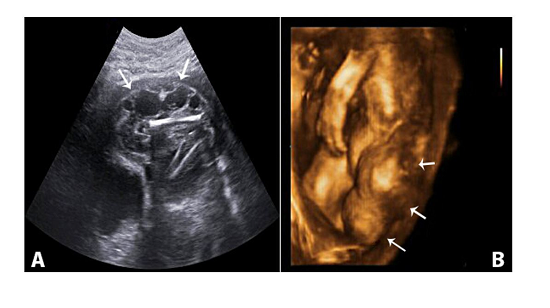 Ultrasonography of a 22+4-week-old fetus with inguinal lymphatic malformation. A - Gray scale sagittal view of prenatal ultrasonography showing abdomino-inguinal lymphatic malformation; B - 3D ultrasonography showing peripheral mass (arrows).