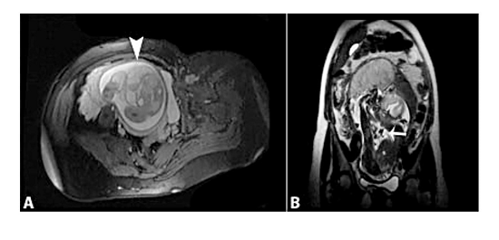 T2-weighted fetal MRI at 24 weeks&rsquo; gestation. a - Axial view showing subcutaneous lymph collection (arrow); b - Coronal view showing lymphatic malformation extending to the knee (arrow).