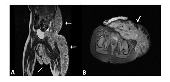 MRI of newborn at the first day of life. A - T2-weighted coronal axis showing the complex cystic/solid pelvic mass (arrows); B - T1-weighted fat saturated axial MRI showing the lymphatic malformation (arrow).