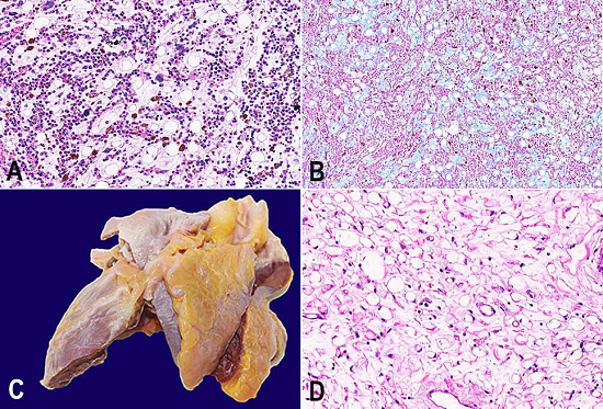 A - Bone marrow with severe hypoplasia and gelatinous material in interstice (H&E, 400X); B - Bone marrow tissue stained with Alcian Blue showing the gelatinous material in interstice, which is an alcianophilic deposit of mucin (Alcian Blue, 400X); C - Gross examination of the heart showing the bright appearance of pericardial adipose tissue, which is an example of gelatinous transformation outside the bone marrow; D - Pericardial adipose tissue with the same histological aspect noted in the bone marrow, which is consistent with the macroscopic aspect of the heart (H&E, 400X). 