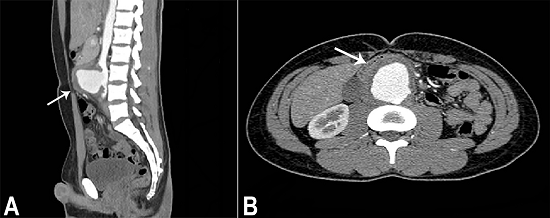 Abdominal CT. A (sagittal plane) - Infrarenal aortic saccular aneurysm presenting irregular contours, ulceration, surrounded by irregular dense tissue (arrow); B (axial plane) - The anterior displacement of the duodenum (arrow).