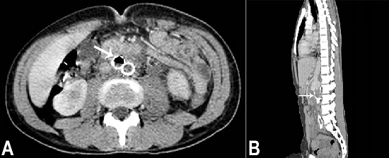 Abdominal CT prior to death. A - (axial plane) Gaseous focus within the endoprosthesis (arrow) indicating aortoenteric fistula; B - (sagittal plane) The presence of thrombi throughout the aortoiliac endoprosthesis (arrow).