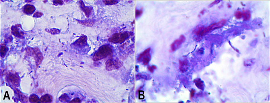 A & B- Photomicrographs of the aneurysm wall showing pleomorphic Gram-positive bacilli (Brown-Hopps, 1000X).