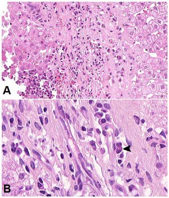 Photomicrography of the liver biopsy performed after 18 months of normal levels of aminotransferases. A - Persistence of periportal activity with a mononuclear inflammatory infiltrate (H&E, 300X); B - Presence of plasma cells (arrowhead) (H&E, 700X).