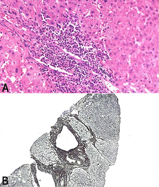 Photomicrography of the liver biopsy undertaken when the patient was under the maximum dose of azathioprine (2.1 mg/kg/day). Note the lack of histological remission. A - Periportal activity with inflammatory infiltrate (H&E, 200X); B - Liver fibrosis with multiple septa-METAVIR fibrosis stage F3 (Reticulin, 50X).