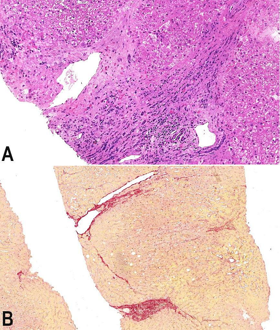 Photomicrography of the liver biopsy after the reduction of the azathioprine dose, and the addition of allopurinol to the prescription. A - Mild periportal activity, with only a spill-over of lymphocytes beyond the interface of the portal tract to the liver parenchyma (H&E, 100X); B - METAVIR fibrosis stage F3 in regression, with perforated septa (Sirius red stain, 50X).