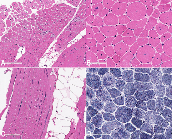 Photomicrography of the muscle biopsy. A - Fiber size variation and centralized nuclei especially in small fibers (H&E); B - Central nuclei are observed in majority of cells (H&E); C - Centrally located nuclei often forming chains in a longitudinal section (H&E); D - Radial arrangement of inter-myofibrillar network (spoke-like appearance) (NADH stain).