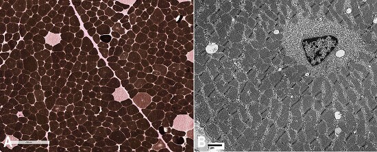 Photomicrography of the muscle biopsy. A - ATPase (pH 4.3) type II fiber hypertrophy and type I fiber predominance (>90%); B - Electronic microscopy: fibers with central nuclei and radial sarcoplasmic strands (X 6300).
