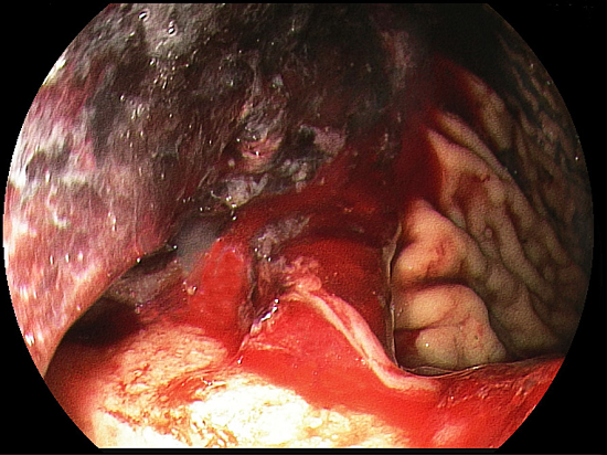 Upper digestive endoscopy showing a protruding ulcerated, infiltrative gastric lesion located in the cardia that presents active bleeding.