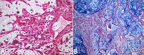 Photomicrography of the gastric biopsy. A - Poorly cohesive atypical cells with cytoplasm vacuoles (signet ring cells) (arrow) in a background of mucin and inflammatory cells (asterisk) (H&E, 400X); B - Pools of mucin (blue) in the background of tumor cells (PAS/Alcian blue stain, 200X).
