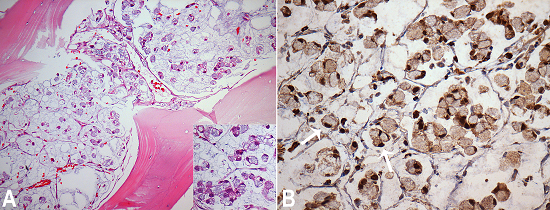 Photomicrography of the bone marrow biopsy. A - Diffuse infiltration by adenocarcinoma with mucinous background (H&E, 200X) and signet ring cells (inset, H&E, 400X); B - Immunohistochemistry for CDX2 showing positive nuclear brown staining in bone marrow signet ring cells (arrow) (400X).