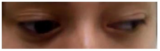 Paresis of the right eye when looking to the left.