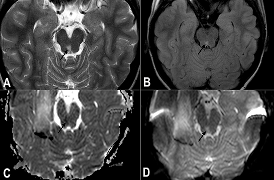 Brain MRI - Axial T2-weighted (A) and FLAIR (B) showing hyperintensity focus in the right periaqueductal region of the midbrain (black arrow). Axial ADC map (C) and DWI (D) show ischemic insult characterized by the restriction of free water molecules in the same region of the midbrain (black arrow). ADC = apparent diffusion coefficient; DWI = diffusion-weighted imaging; FLAIR = fluid-attenuated inversion recovery sequence; MRI = magnetic resonance imaging.