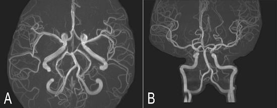 Cerebral magnetic resonance angiography (3D reconstructions). Oblique axial (A) and oblique coronal (B) images show normal intracranial arteries. 