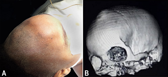 A - Panoramic view of the shaved head showing deformity of the left frontal bone; B - Computed tomography (CT) 3-D reconstruction showing a volume rendering view showing a protrusion of the left frontal bone.