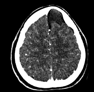 Brain CT - Axial view showing the left frontal cyst compressing the left frontal lobe.