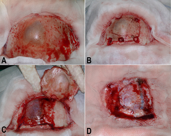 Intra operative steps. A - Macroscopic view of the left frontal bone showing a lilac color deformity; B - Six burr holes surrounding the protruding bone; C - The bone flap, the cyst, and the superior sagittal sinus; D - The duramater closed in a watertight fashion and the superior sagittal sinus.