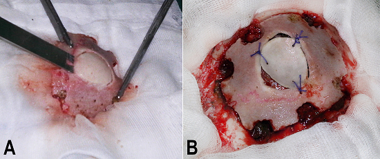 Bone flap management and replacement. A - Creating a free, smaller concave-convex fragment from the bone flap; B - The bone flap on the surgical area with the smaller concave-convex fragment fixed and the deformed surface inverted.