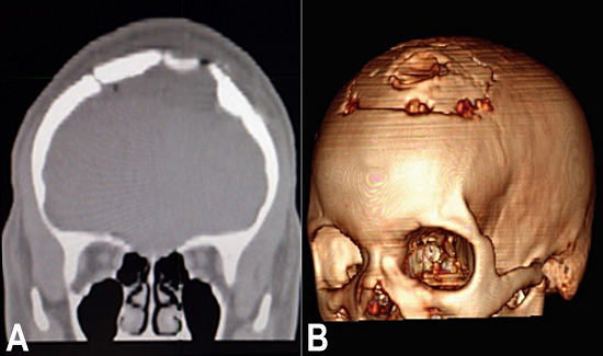 Brain CT. A - Coronal view showing the bone reconstruction after the inversion of the deformed surfaces, and the absence of the cystic lesion; B - 3-D reconstruction showing the restoration of the skull at the area of the craniotomy.