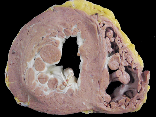 Gross view of the mid-ventricular transversal section of the heart showing extensive areas of white fibrosis in the endocardium of the left ventricle that has diffusely thickened the lining of the chamber and involved the papillary muscles. Note the presence of trabeculae that extend across the myocardium.