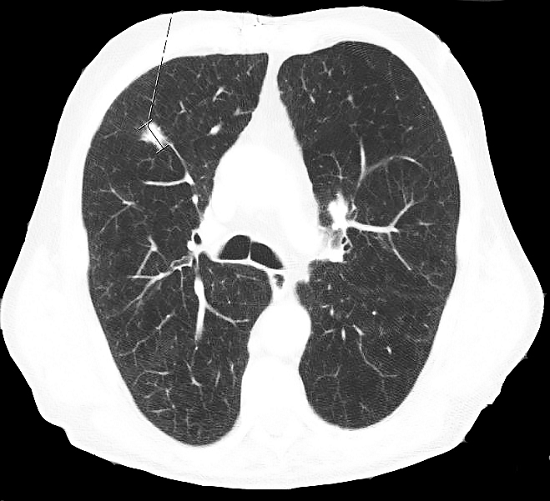 Chest computed tomography scan revealing an irregular 19 mm nodule in the right superior lobe.