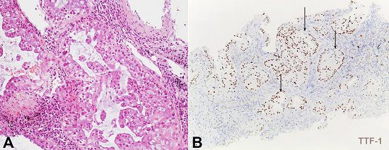 Microphotography of the lung biopsy. A - Acinar adenocarcinoma, with moderate pleomorphism (H&E, 200X); B - Positivity for TTF-1 (100X).