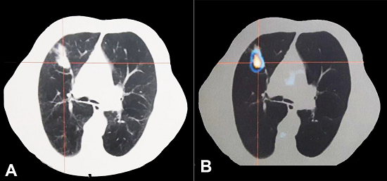 Chest positron emission tomography-computed tomography (PET-CT) (5 months after first CT, 3 months after biopsy). A - Axial CT acquisition; B - Increased 18F-deoxyglucose (FDG) uptake in the right superior lobe (standardized uptake value max = 6.8) without other FDG captation.