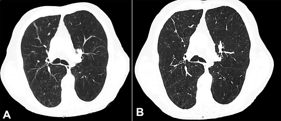 Chest computed tomography (CT). A - Six months after first CT and 4 months after the biopsy; note the vanishing of the right superior lobe 19 mm nodule; B - Absence of the nodule relapse 3 years after the diagnosis.