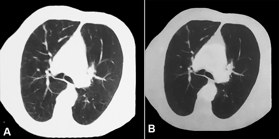 Chest positron emission tomography-computed tomography (PET-CT) performed 1 year after diagnosis. A - CT axial image acquisition; B - Absence of 18F-deoxyglucose captation.