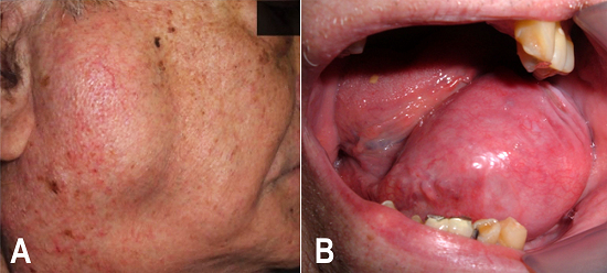 Clinical presentation of mantle cell lymphoma. A - The right parotid gland and submandibular regions are affected; B - A tumor mass is observed intraorally on the left side of the floor of the mouth.