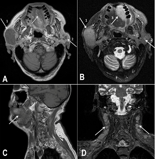 Cervical MRI: Axial view of: A - T1W image; B - T2W image. (1) Superficial lobe of the right parotid gland affected by the MCL. (2) Nodular formations in the superficial lobe of the left parotid gland. (3) Expansive lesion in the palate; C - Sagittal view of T1W image showing a tumor mass affecting the palate and its continuity to the pharyngeal airspace; D - Coronal view of T2W image showing the involvement of cervical lymph nodes. MRI = magnetic resonance imaging; T1W = T1-weighted; T2W = T2-weighted.