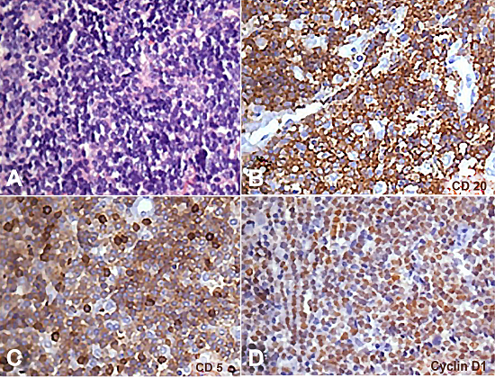 Photomicrography of the biopsy specimen. A - Monotonous lymphoid proliferation of small- to medium-sized lymphocytes (H&E, 100X); B, C, and D - Immunohistochemical profile showing positivity for CD20, CD5, and cyclin D1 in the neoplastic cells (400X).